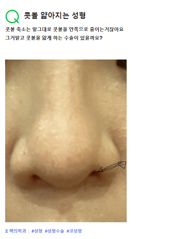 Q. 넓은 콧볼을 안쪽으로 좁게 줄이는 수술? (콧볼축소술)
