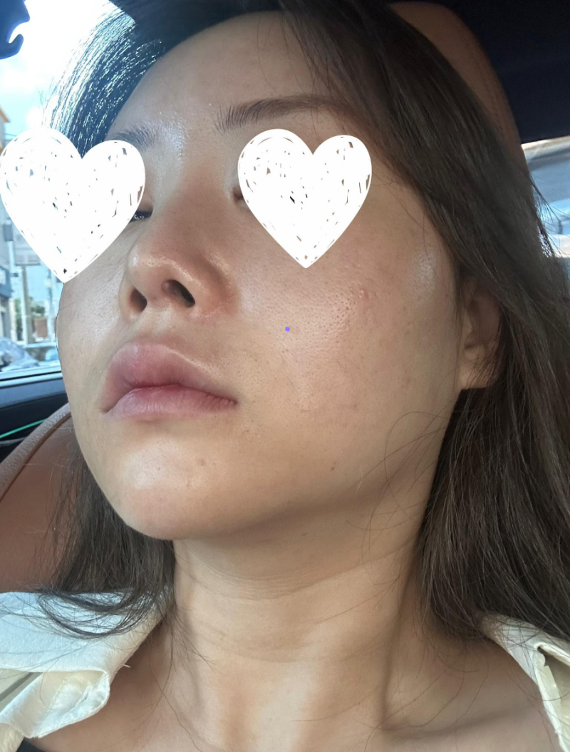 자가늑연골 코재수술, 수술을 통해 고민해결 했어요!
