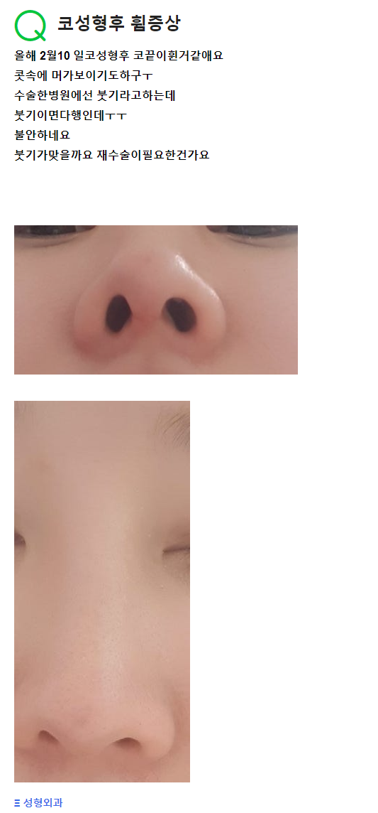 Q. 코성형 후 비중격연골 코휘어짐(휘어진코) 증상