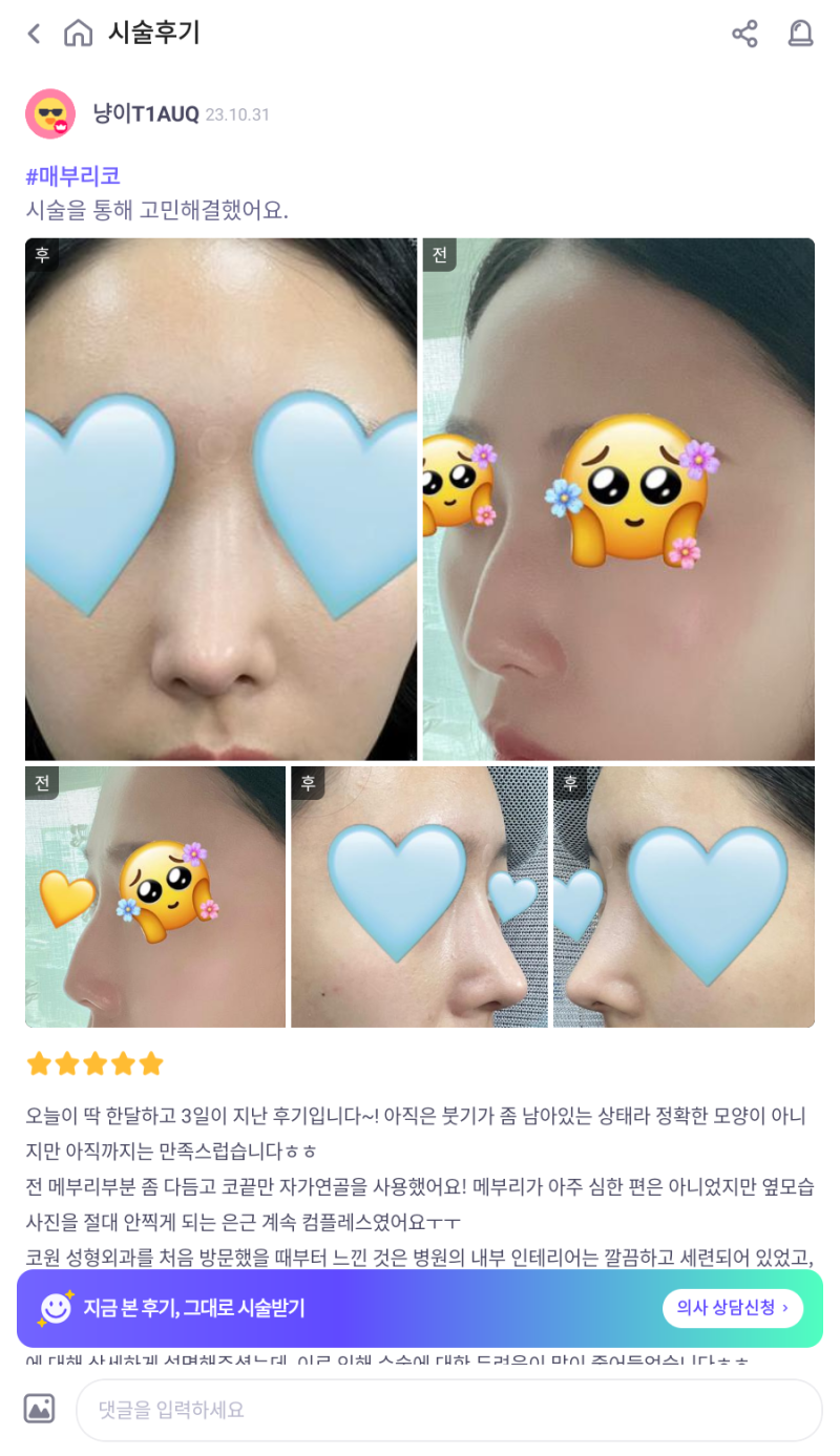 매부리코교정, 비염수술코성형까지 한번에 해결 됐어요! 사진 6