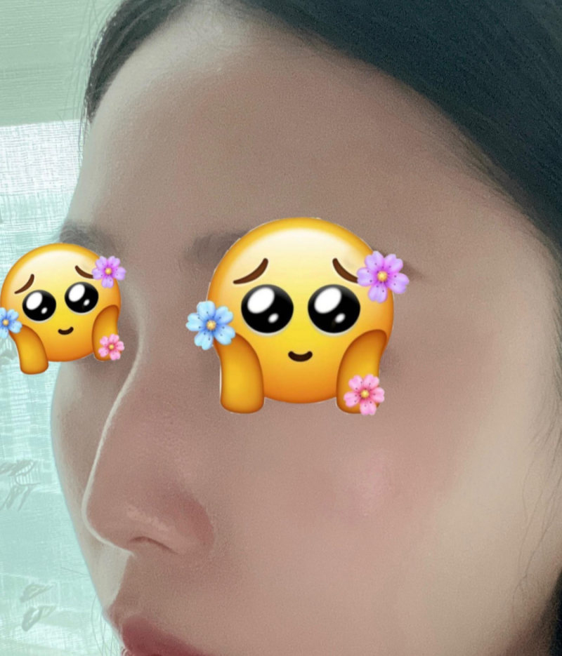 매부리코교정, 비염수술코성형까지 한번에 해결 됐어요!