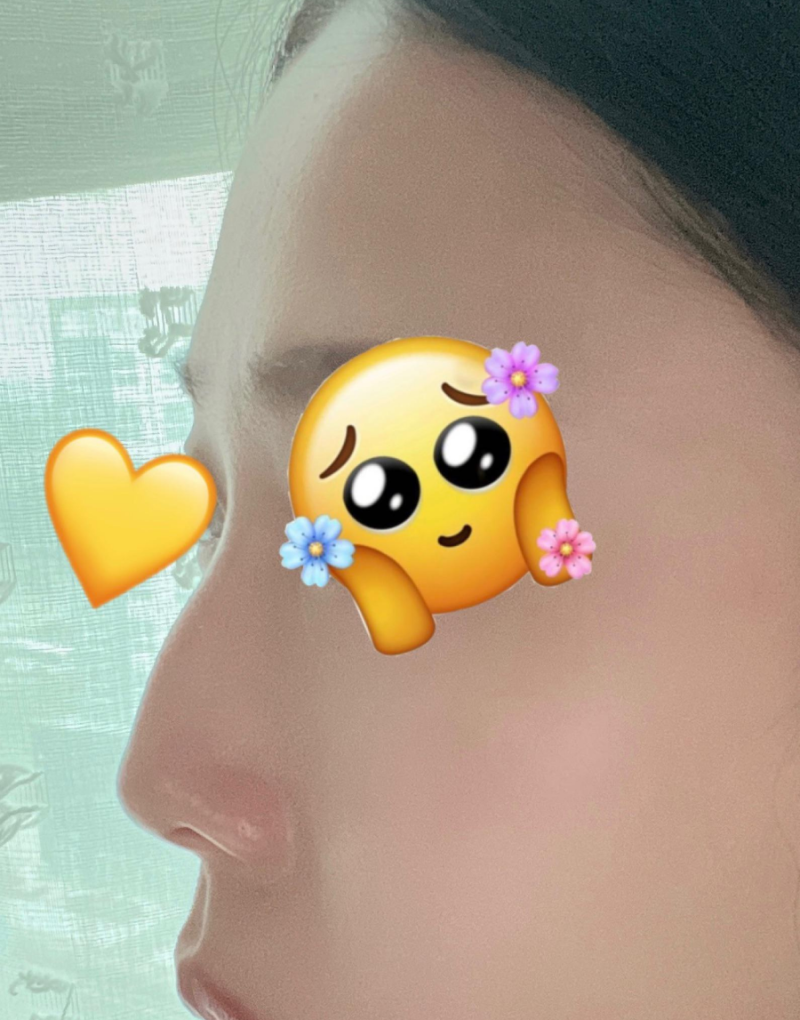 매부리코교정, 비염수술코성형까지 한번에 해결 됐어요!