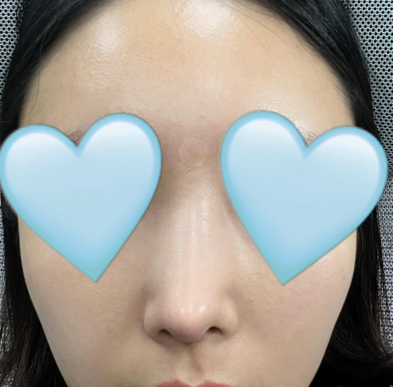 매부리코교정, 비염수술코성형까지 한번에 해결 됐어요! 사진 3