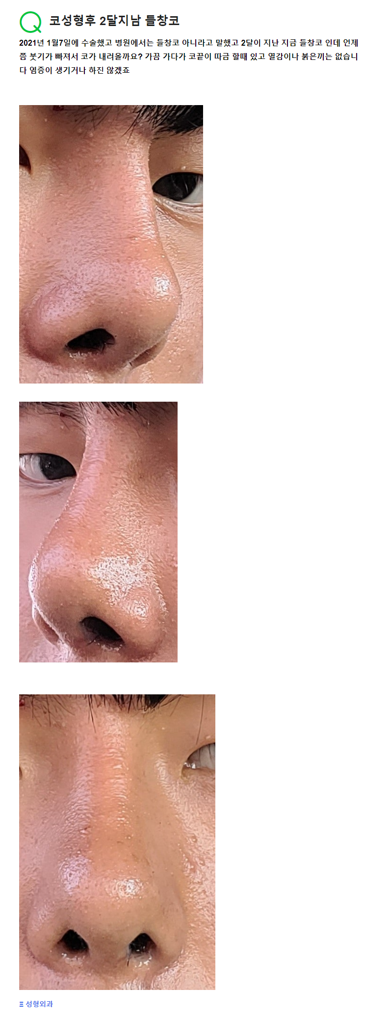 Q. 코성형 하고 2달 뒤 생긴 들창코와 부작용에 대한 문의