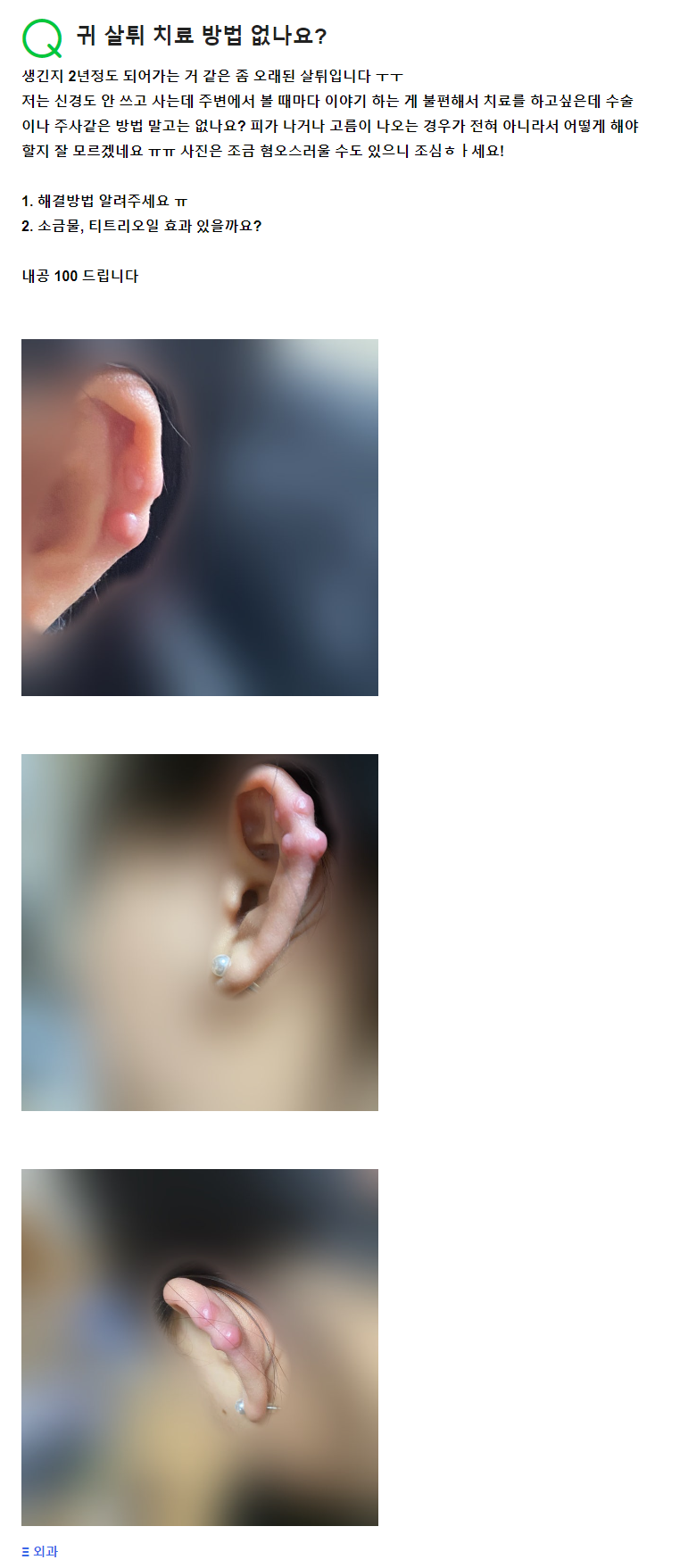 Q. 귀 뚫은 곳 몽우리, 귀켈로이드 때문에 고민이에요.