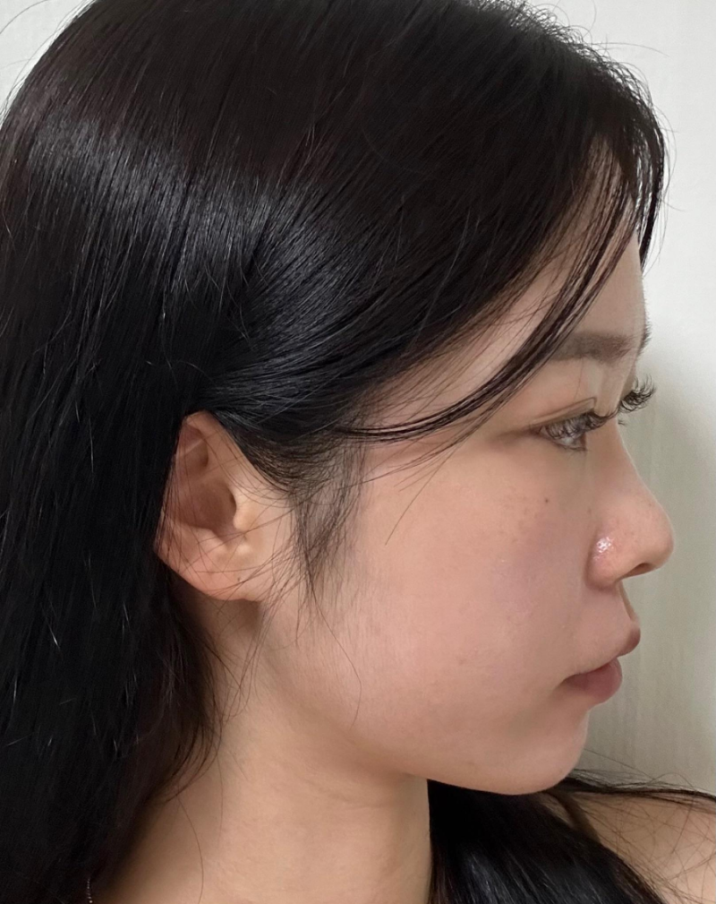 비순각수술로 낮은코성형을 성공해 제가 원하는 코모양을 얻었어요!