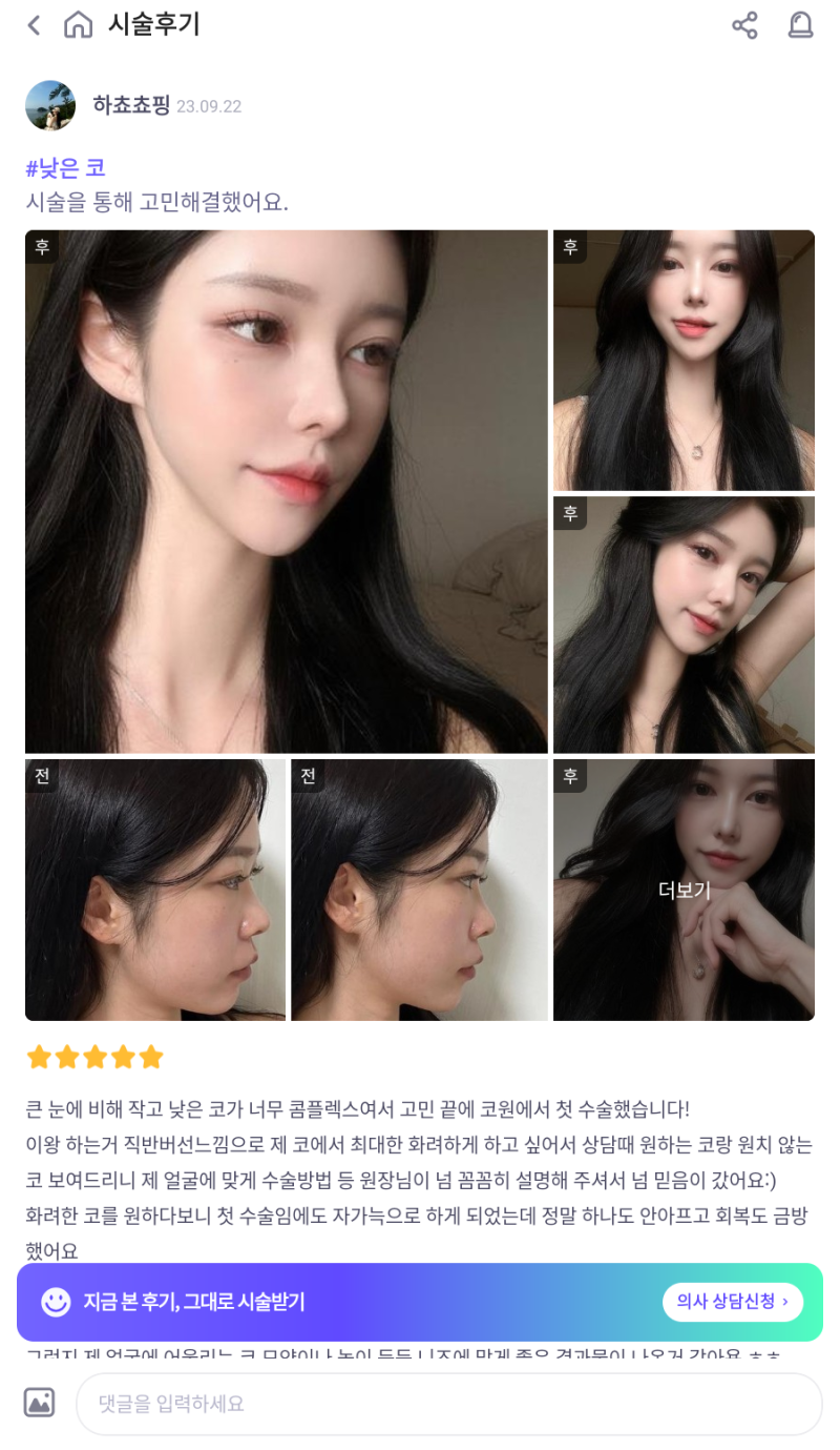 비순각수술로 낮은코성형을 성공해 제가 원하는 코모양을 얻었어요! 사진 10