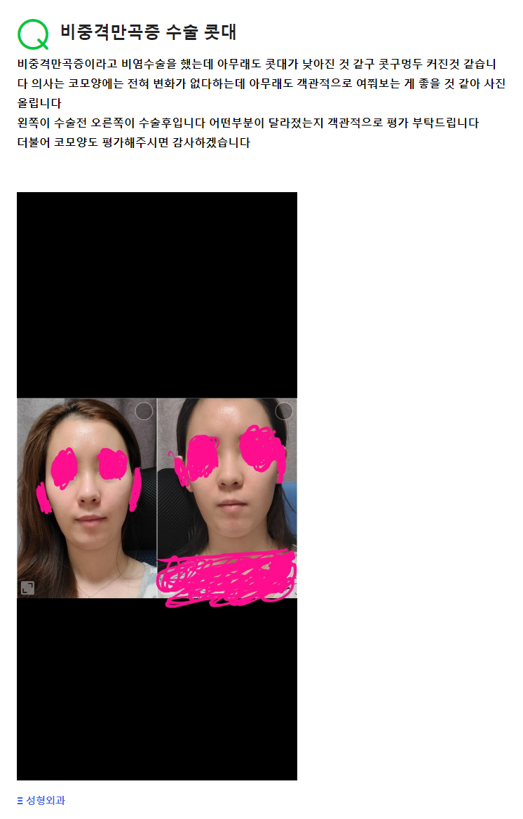 Q. 기능코수술(비염코), 비중격만곡증 수술 후 콧대 관련 질문