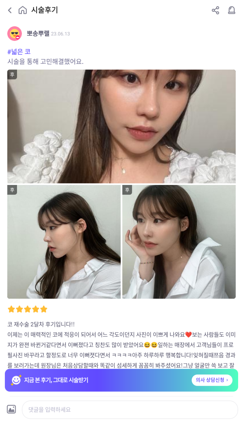 자가늑 코재수술로 비순각수술을 해서 저에게 어울리는 코를 찾았어요! 사진 4