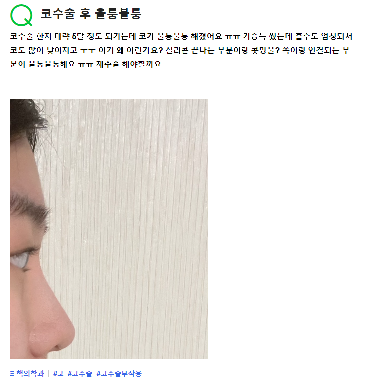 Q. 코 울퉁불퉁 한거 때문에 신경쓰입니다