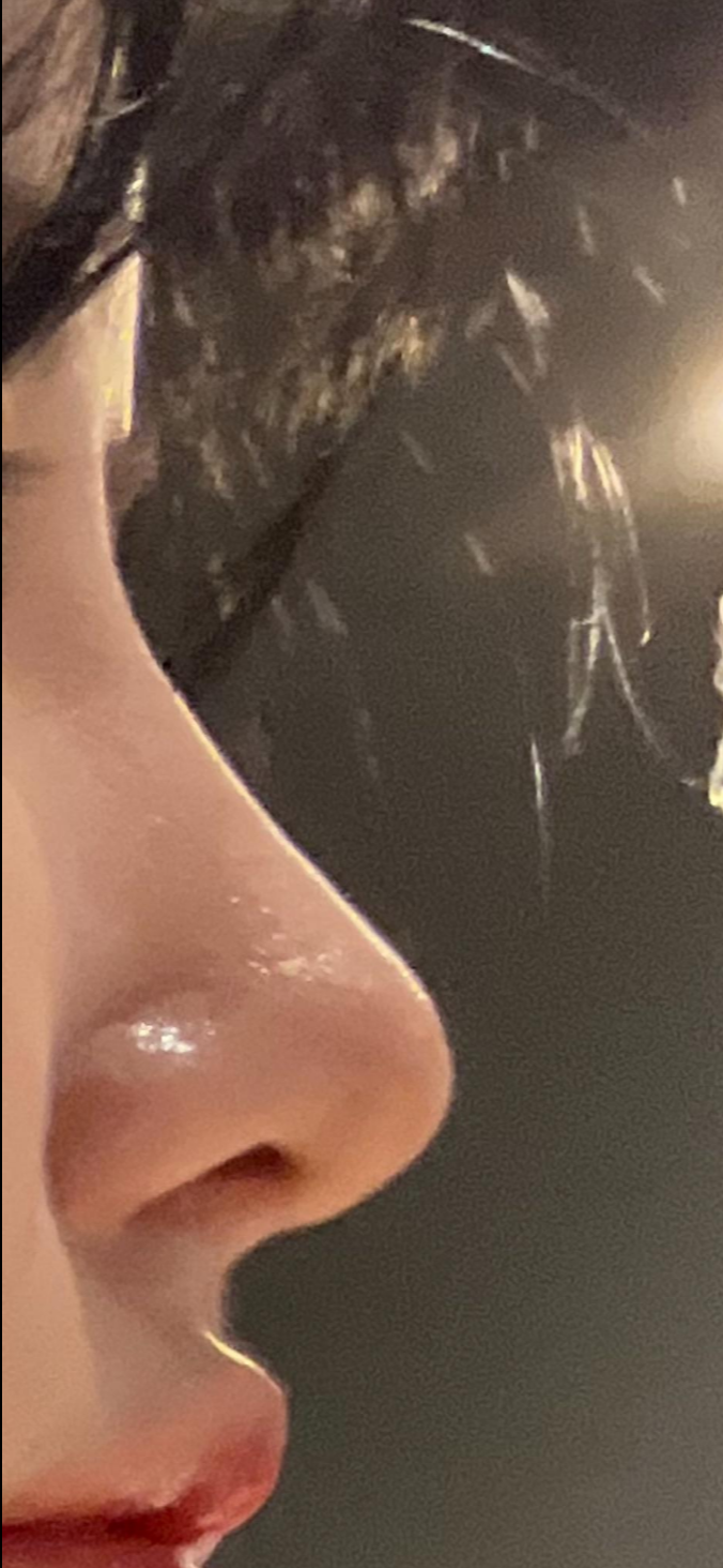 울퉁불퉁해 신경 쓰이던 코를 코원성형외과에서 낮은코와 매부리코교정으로 매끄럽게 만들었어요! 사진 8