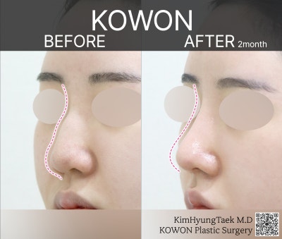 울퉁불퉁해 신경 쓰이던 코를 코원성형외과에서 낮은코와 매부리코교정으로 매끄럽게 만들었어요! 사진 22
