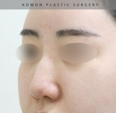 울퉁불퉁해 신경 쓰이던 코를 코원성형외과에서 낮은코와 매부리코교정으로 매끄럽게 만들었어요! 사진 11