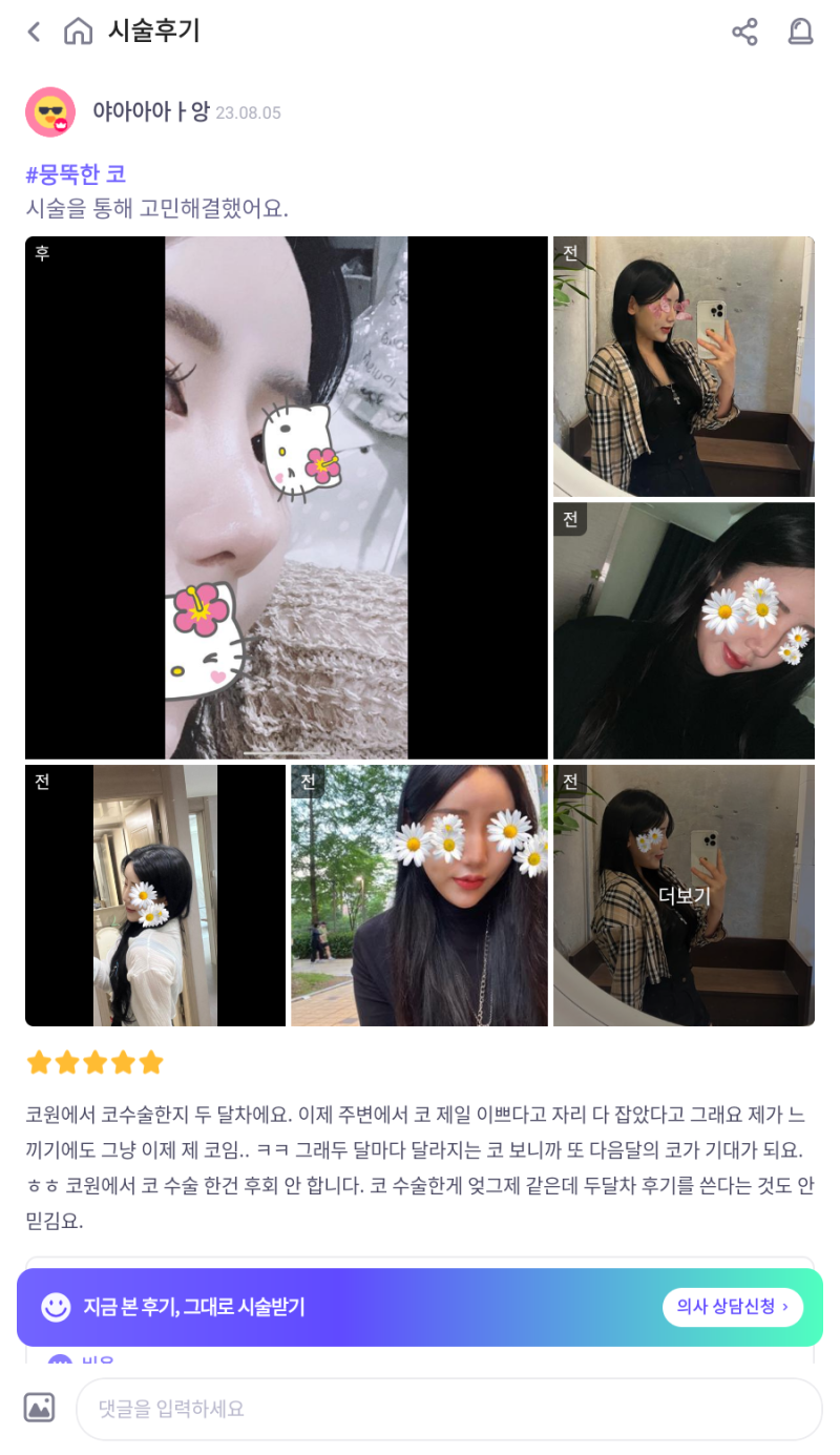 울퉁불퉁해 신경 쓰이던 코를 코원성형외과에서 낮은코와 매부리코교정으로 매끄럽게 만들었어요! 사진 10
