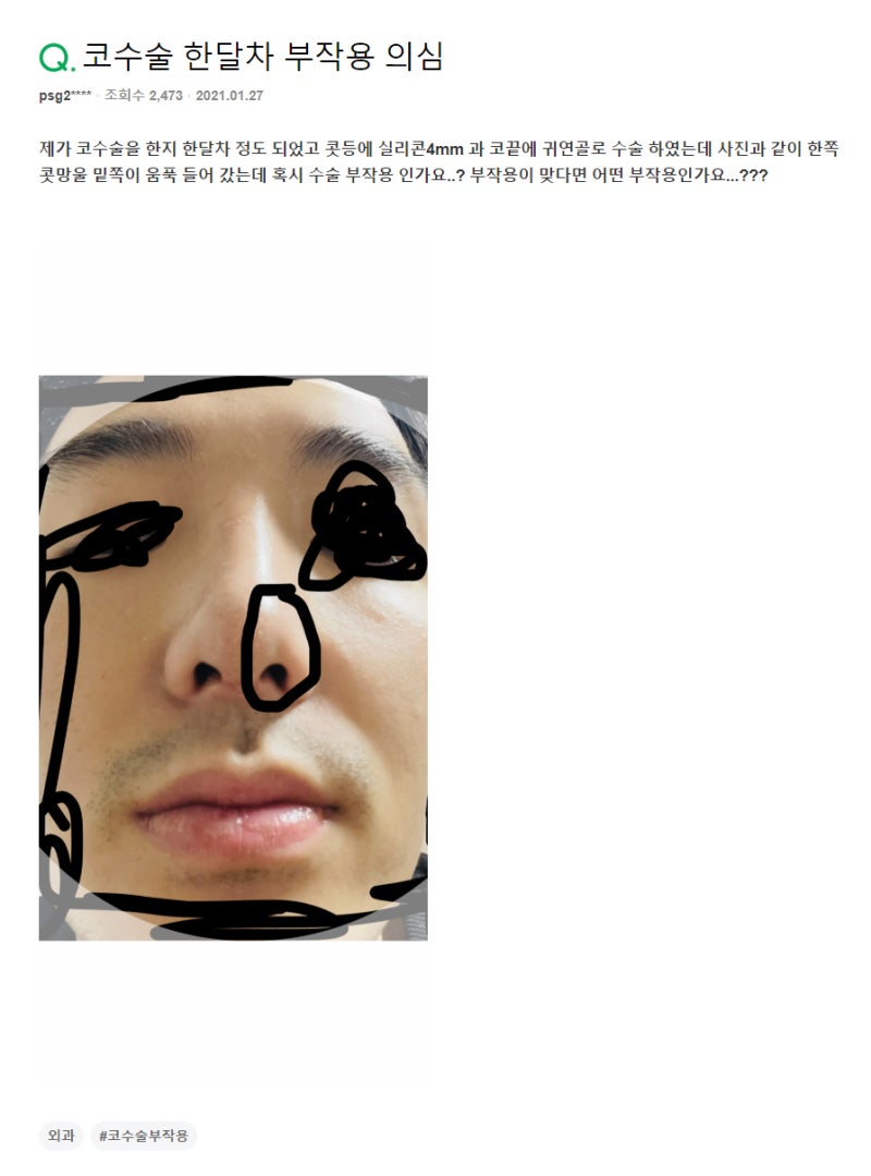 Q. 코수술부작용 일까요? 코끝귀연골로 수술 했습니다
