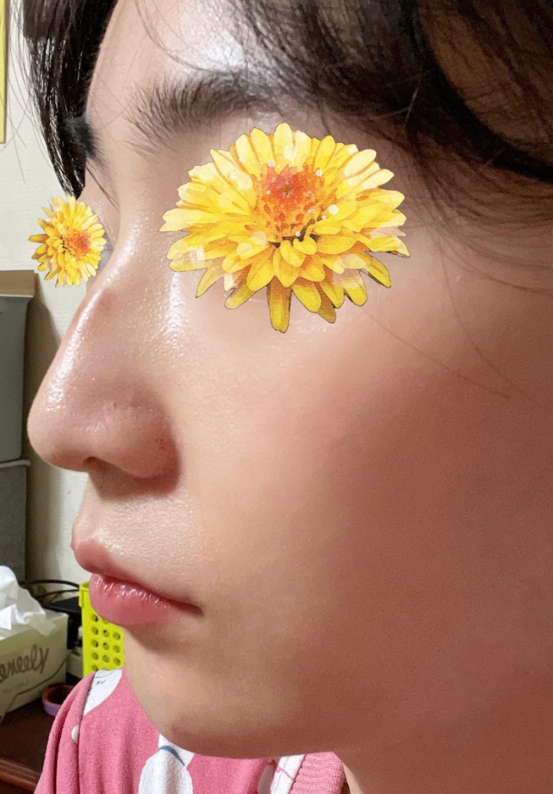 여자매부리코와 화살코 교정을 코원성형외과에서 하고 딱 원하는 라인을 찾게 되었어요! 사진 3