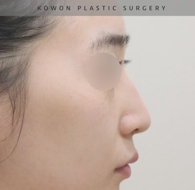 여자매부리코와 화살코 교정을 코원성형외과에서 하고 딱 원하는 라인을 찾게 되었어요! 사진 10