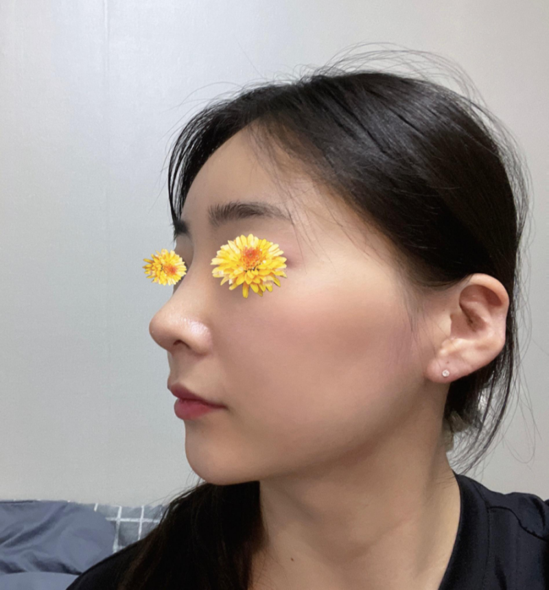 여자매부리코와 화살코 교정을 코원성형외과에서 하고 딱 원하는 라인을 찾게 되었어요! 사진 6
