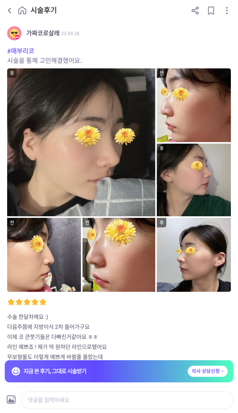 여자매부리코와 화살코 교정을 코원성형외과에서 하고 딱 원하는 라인을 찾게 되었어요! 사진 7