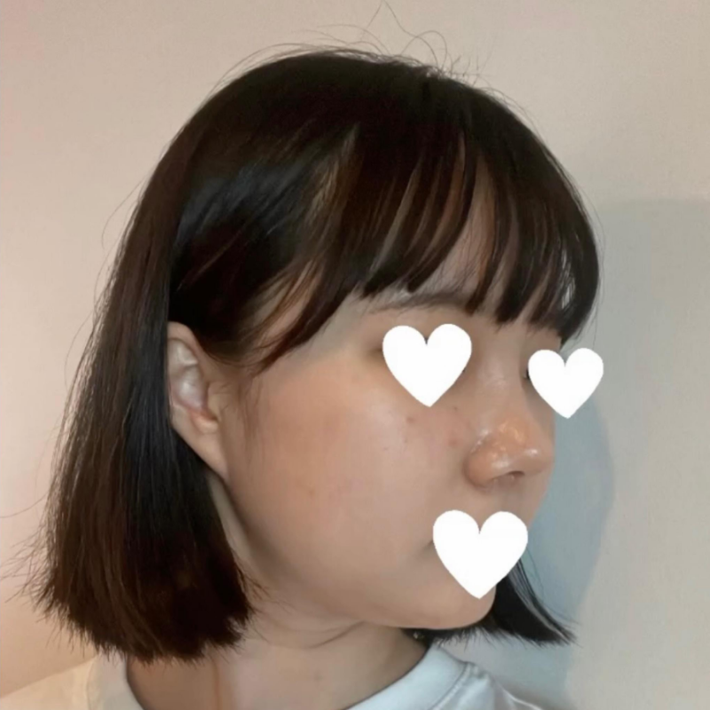 코원성형외과에서 작고 뭉뚝한코 교정과 비중격만곡증 기능코수술로 다시 태어났어요 사진 7