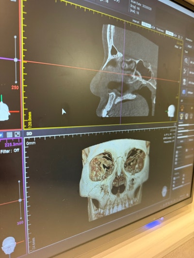 코원성형외과에서 작고 뭉뚝한코 교정과 비중격만곡증 기능코수술로 다시 태어났어요 사진 14