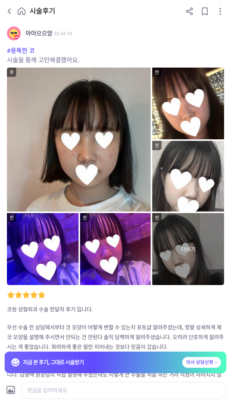 코원성형외과에서 작고 뭉뚝한코 교정과 비중격만곡증 기능코수술로 다시 태어났어요 사진 10