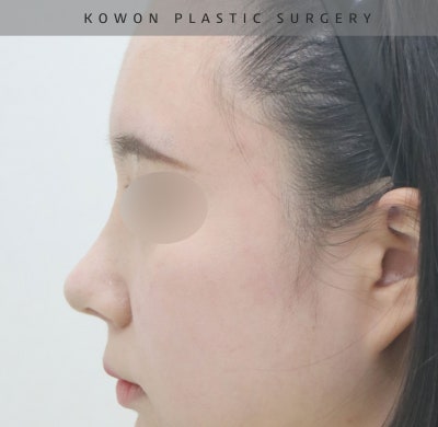 코원성형외과에서 작고 뭉뚝한코 교정과 비중격만곡증 기능코수술로 다시 태어났어요 사진 12