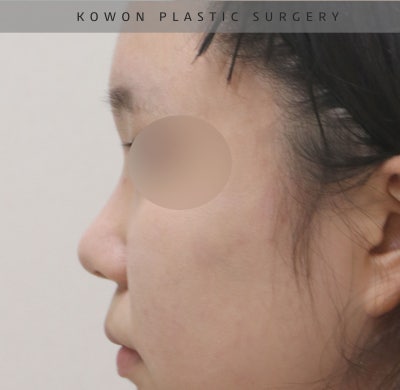코원성형외과에서 작고 뭉뚝한코 교정과 비중격만곡증 기능코수술로 다시 태어났어요 사진 11