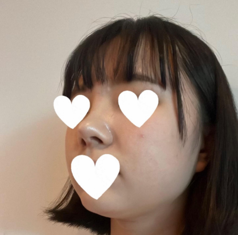 코원성형외과에서 작고 뭉뚝한코 교정과 비중격만곡증 기능코수술로 다시 태어났어요 사진 9