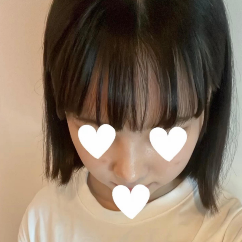 코원성형외과에서 작고 뭉뚝한코 교정과 비중격만곡증 기능코수술로 다시 태어났어요 사진 8