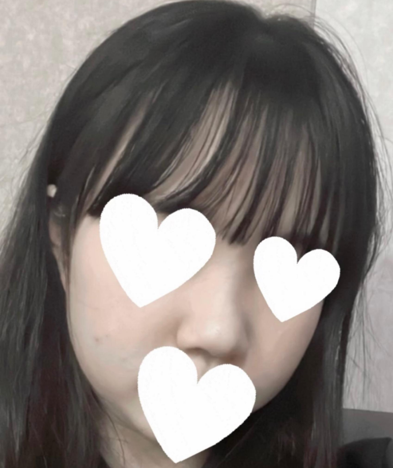 코원성형외과에서 작고 뭉뚝한코 교정과 비중격만곡증 기능코수술로 다시 태어났어요 사진 4