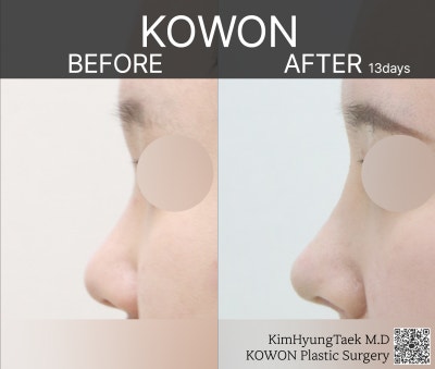 코원성형외과에서 작고 뭉뚝한코 교정과 비중격만곡증 기능코수술로  다시 태어났어요