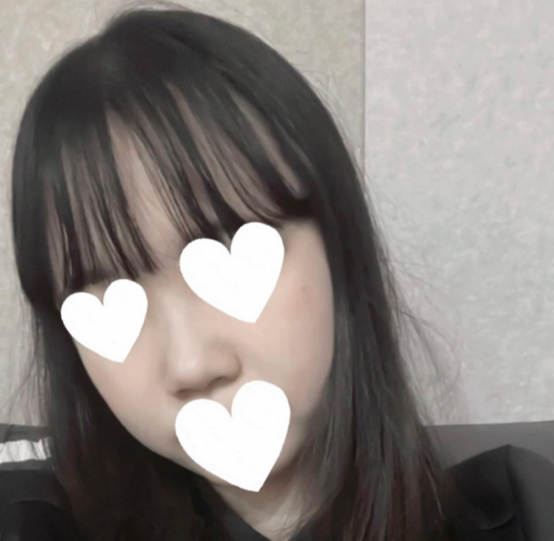 코원성형외과에서 작고 뭉뚝한코 교정과 비중격만곡증 기능코수술로 다시 태어났어요 사진 5