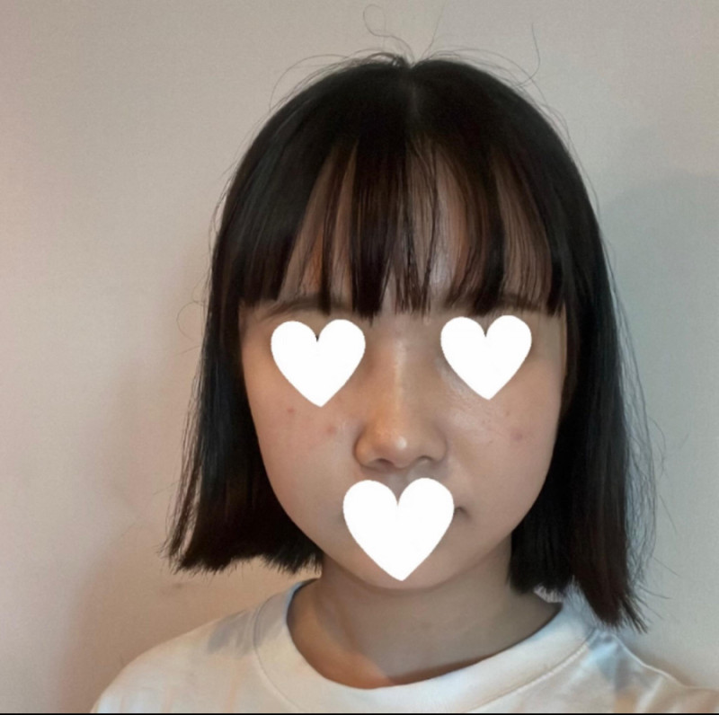 코원성형외과에서 작고 뭉뚝한코 교정과 비중격만곡증 기능코수술로 다시 태어났어요