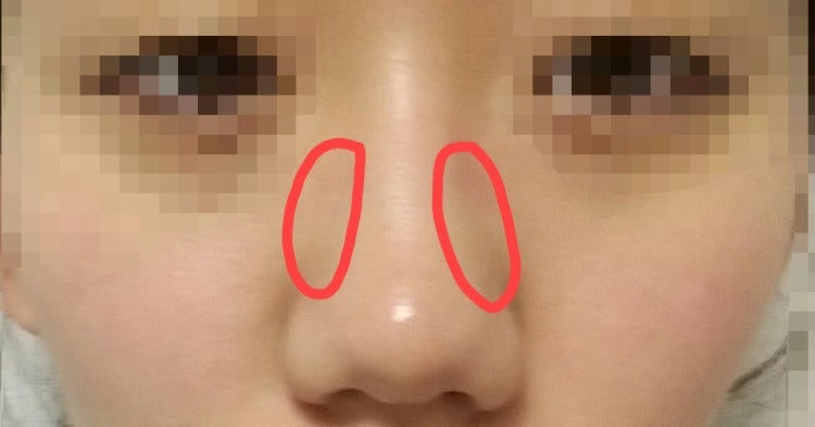 Q. 코성형 할건데 코성형종류 알려주세요(복코수술)