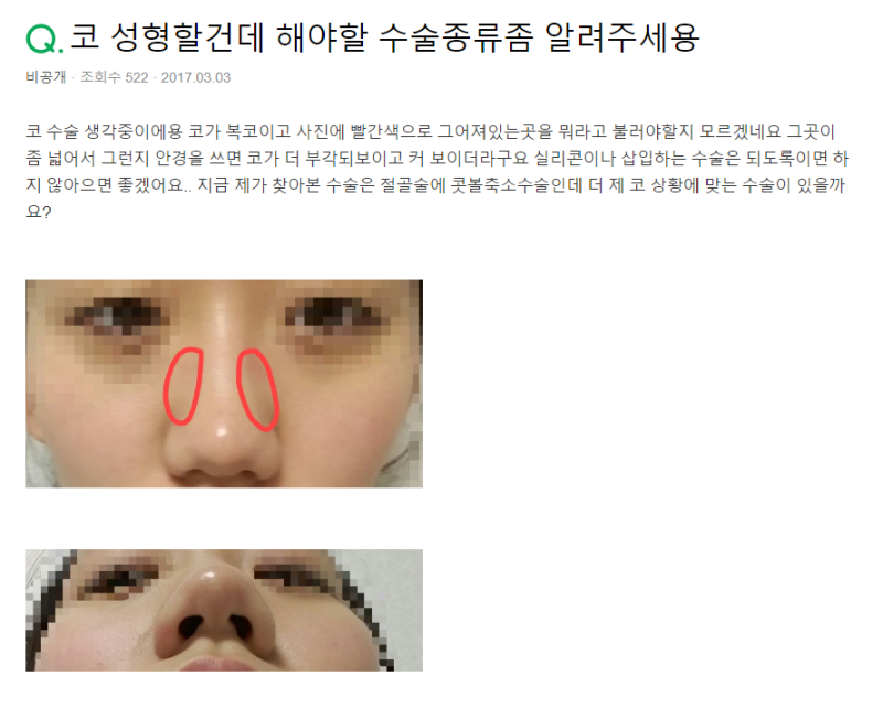 Q. 코성형 할건데 코성형종류 알려주세요(복코수술) 사진 2