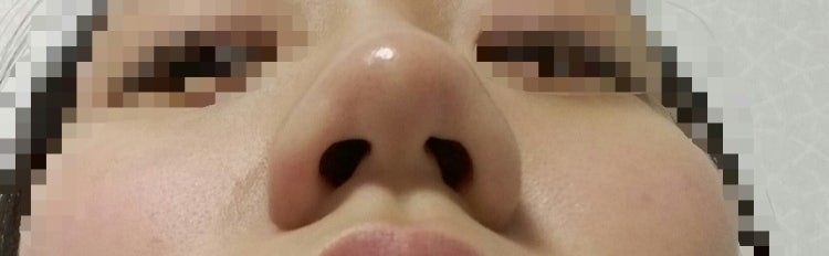 Q. 코성형 할건데 코성형종류 알려주세요(복코수술) 사진 4