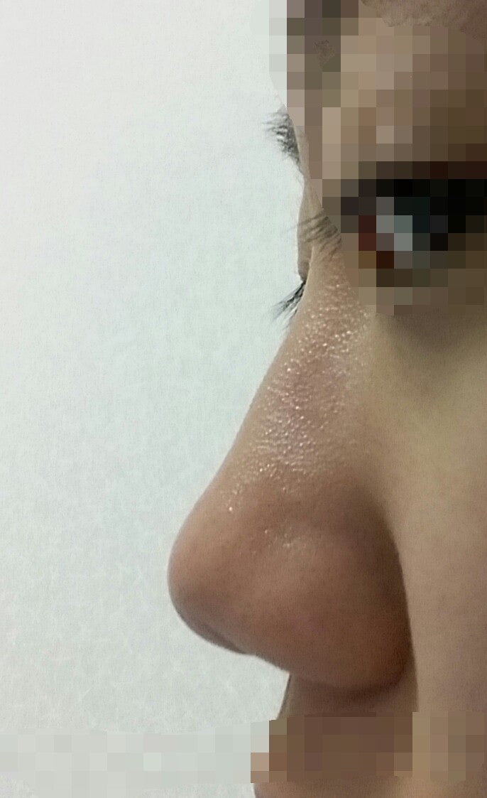 Q. 코성형 할건데 코성형종류 알려주세요(복코수술) 사진 5