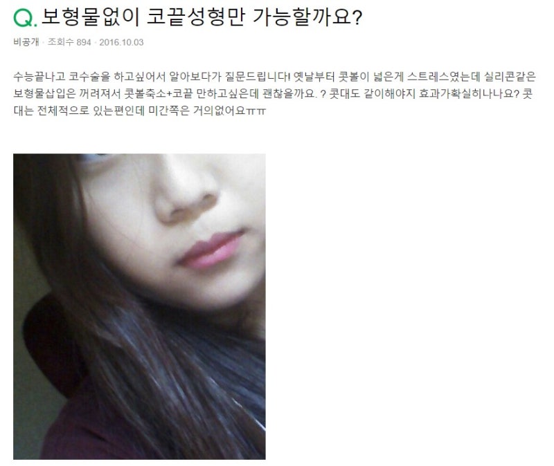 무보형물코수술로 콧볼축소와 코끝 성형 가능할까요? 사진 2