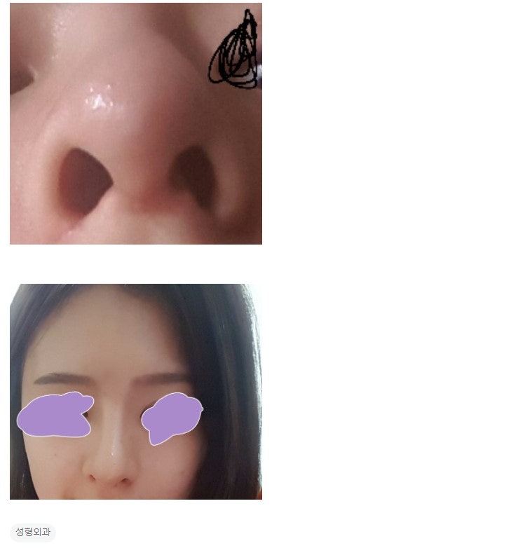 Q. 수술한지 2개월, 코재수술 하고 싶어요. (비중격연골 문제) 사진 3