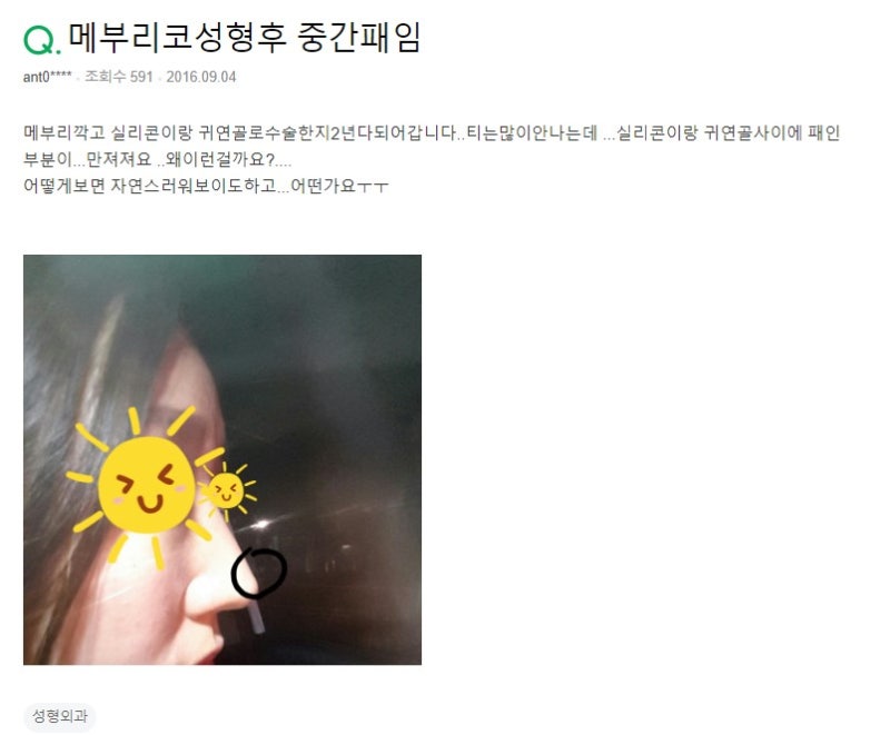 Q. 매부리코 개선 성형했는데 코함몰 된 건가요?