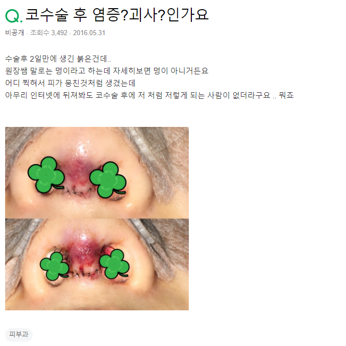 Q. 코성형괴사? 코성형염증?? 부작용인지 봐주세요.. 사진 2