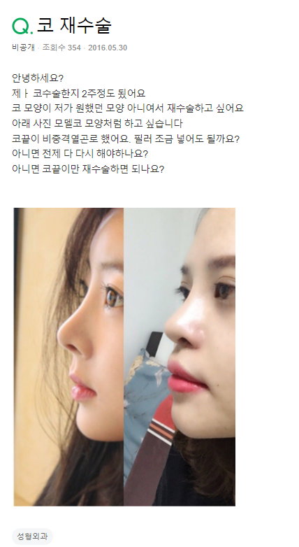 Q. 비중격 연골로 수술했는데 코재수술하고 싶어요.. 사진 2