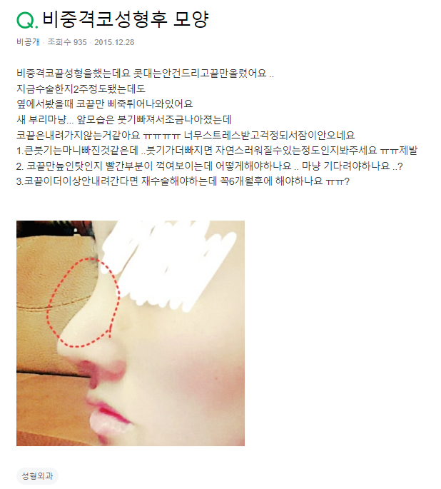 Q. 비중격코끝성형, 부자연스러워요.. feat. 코 부기