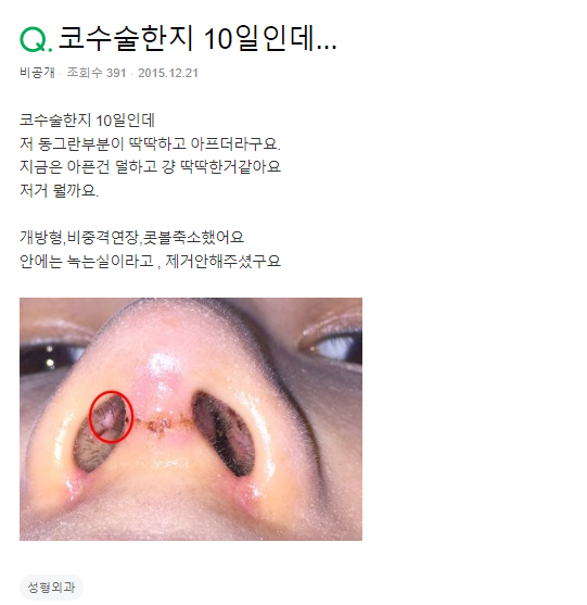 Q. 코수술 10일차, 이게 뭘까요?