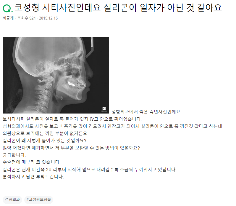 Q. 매부리코 성형 후 실리콘 꺼짐 (CT사진 첨부)