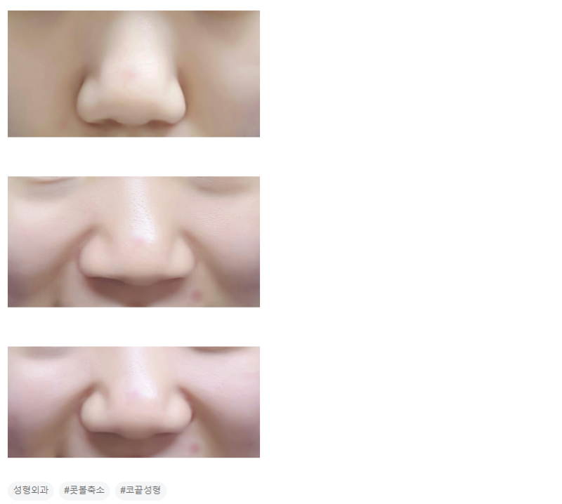 Q. 코끝이 뭉툭하고 웃을 때 퍼진코가 심해져요.. 사진 3