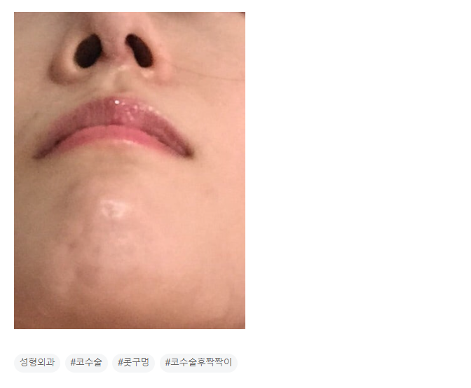 Q. 코수술 했는데 눈과 콧구멍 짝짝이로..