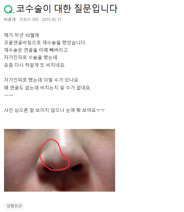 Q. 연골비침 재수술, 진피지방 이식했는데 또 비쳐요.