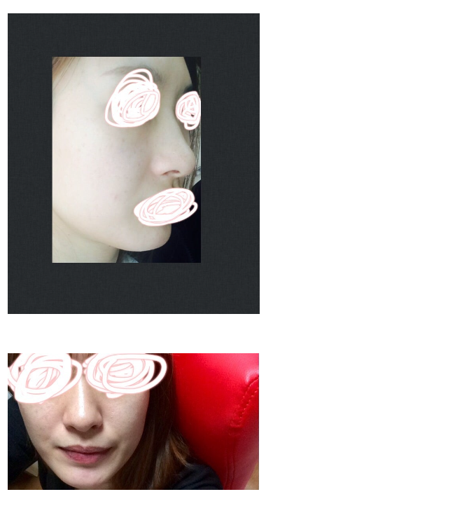 Q. 매부리 코, 비중격으로 개선해야 할까요? 사진 3